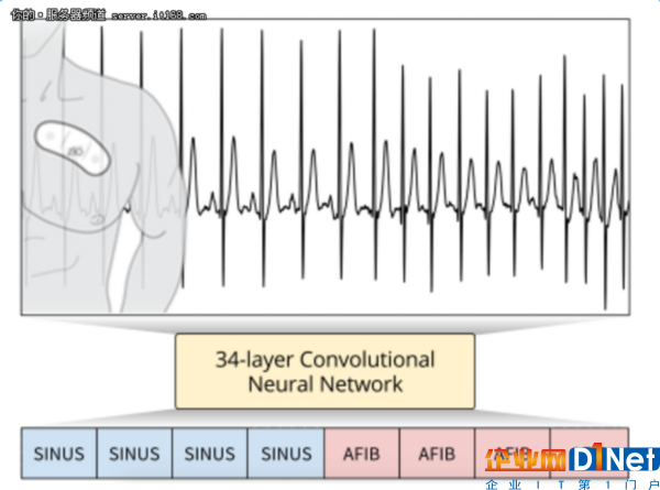 新的深度學(xué)習(xí)算法可診斷心律失常